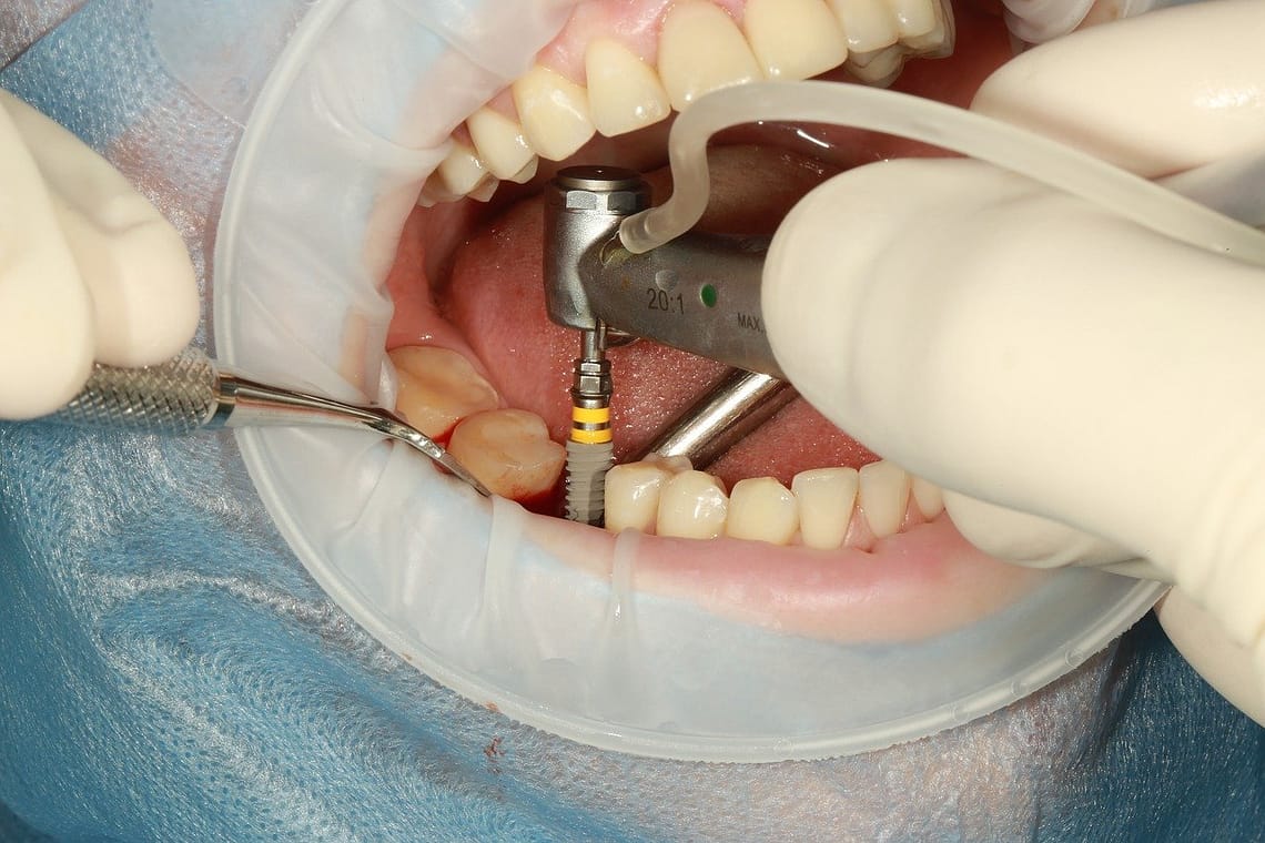 dental surgery tooth
