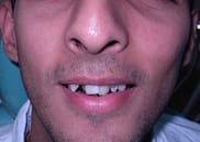 crowded teeth