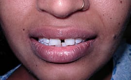 natural smile