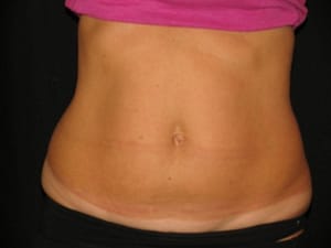 Natural fat reduction