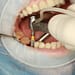 dental surgery tooth